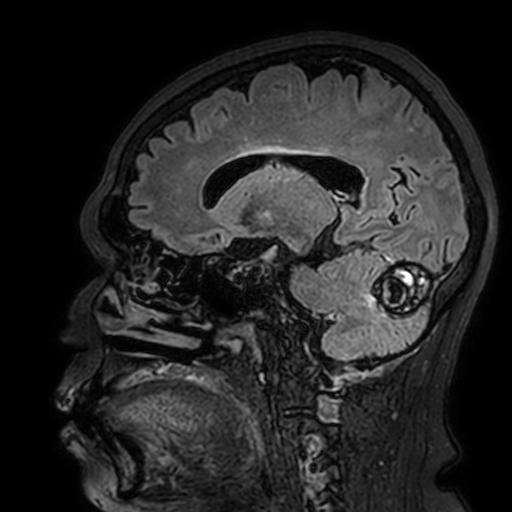 Cavernous hemangioma of the cerebellar falx (Radiopaedia 73025-83724 Sagittal FLAIR 83).jpg