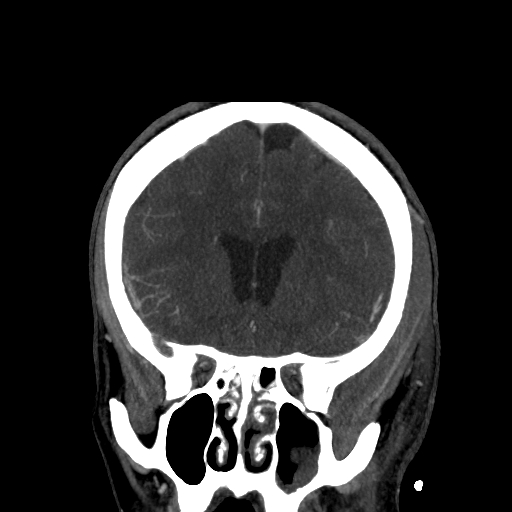 File:Cavernous sinus thrombosis (Radiopaedia 10619-11078 D 8).jpg