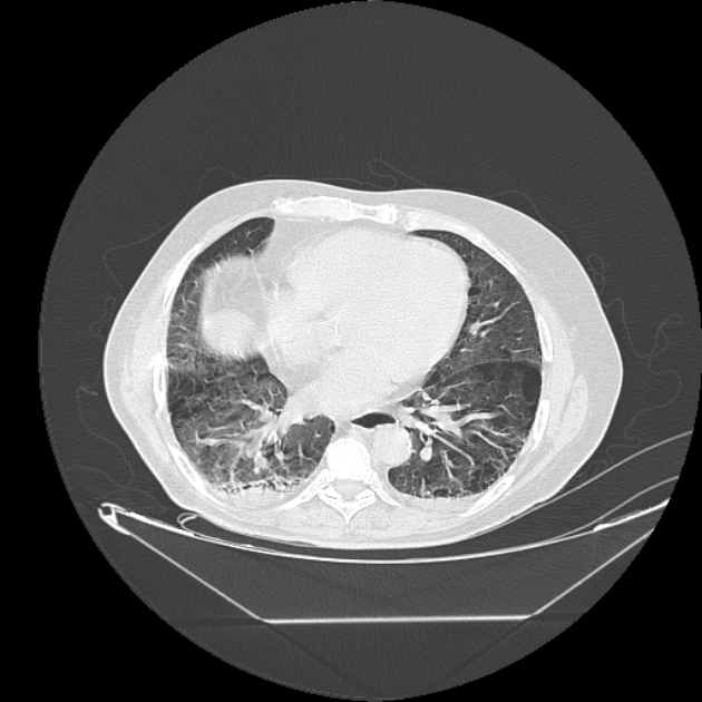 Cavitating bronchogenic carcinoma (Radiopaedia 44489-48162 Axial lung window 55).jpg