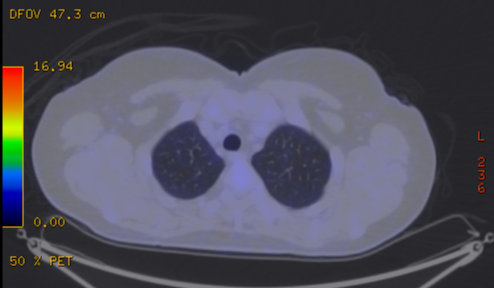 File:Cavitating lung mass - squamous cell carcinoma (Radiopaedia 48047-52853 A 20).png