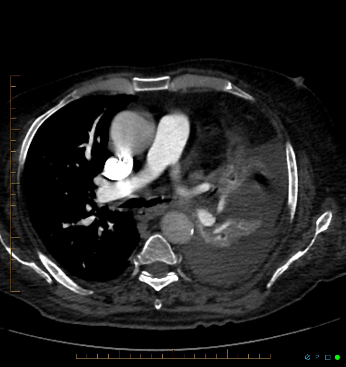 Cavitating pulmonary infarction (Radiopaedia 54634-60849 Axial C+ CTPA 33).jpg