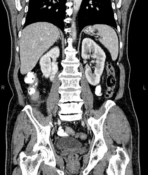 Cecal cancer with appendiceal mucocele (Radiopaedia 91080-108651 D 48).jpg