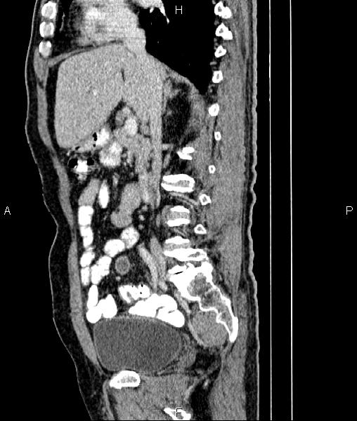 File:Cecal cancer with appendiceal mucocele (Radiopaedia 91080-108651 E 41).jpg