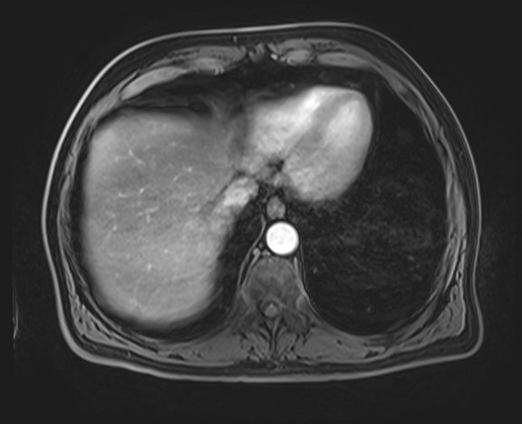 Cecal mass causing appendicitis (Radiopaedia 59207-66532 H 25).jpg
