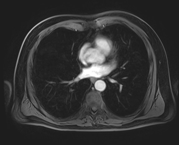 Cecal mass causing appendicitis (Radiopaedia 59207-66532 H 6).jpg