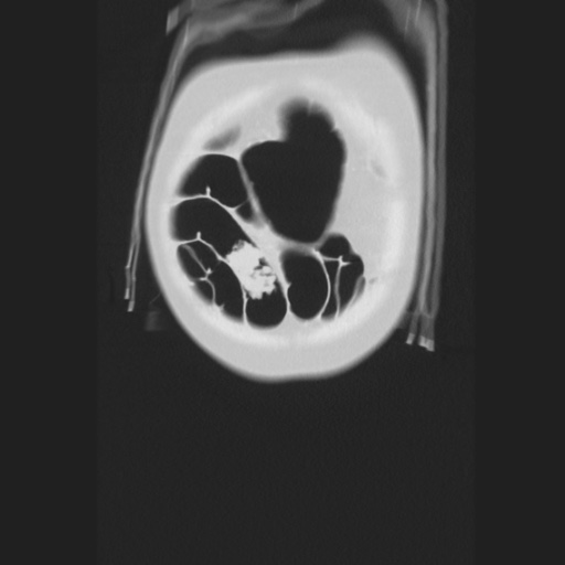 Cecal volvulus (Radiopaedia 75378-86620 Coronal lung window 20).jpg