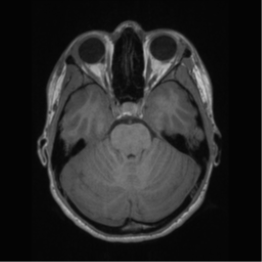 File:Central neurocytoma (Radiopaedia 37664-39557 Axial T1 22).png