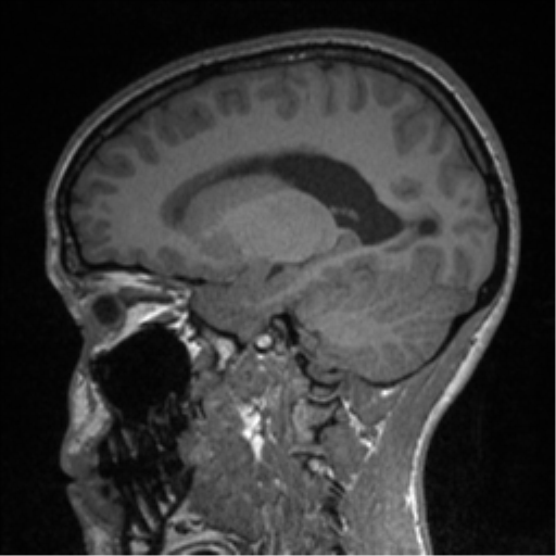 Central neurocytoma (Radiopaedia 37664-39557 Sagittal T1 62).png