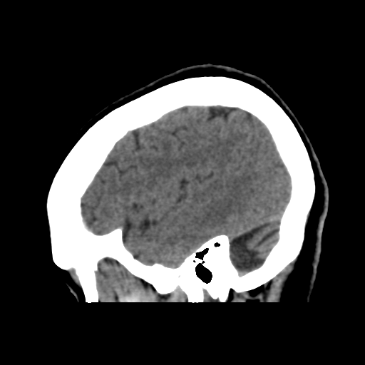 File:Central neurocytoma (Radiopaedia 65317-74346 C 13).png