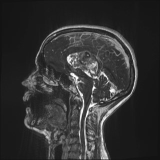 Central neurocytoma (Radiopaedia 84497-99872 Sagittal CISS 40).jpg