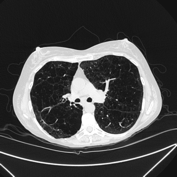 Centrilobular pulmonary emphysema (Radiopaedia 24495-24789 Axial lung window 42).jpg