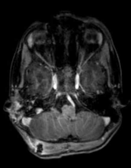 Cerebellar abscess (Radiopaedia 73727-84563 Axial T1 C+ fat sat 41).jpg