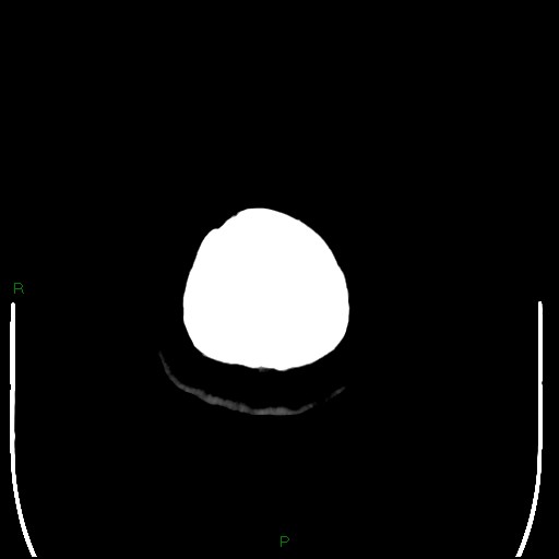 Cerebellar abscess (Radiopaedia 78135-90671 Axial non-contrast 113).jpg