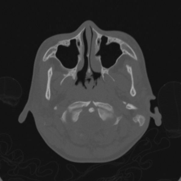 File:Cerebellar abscess secondary to mastoiditis (Radiopaedia 26284-26413 Axial bone window 13).jpg