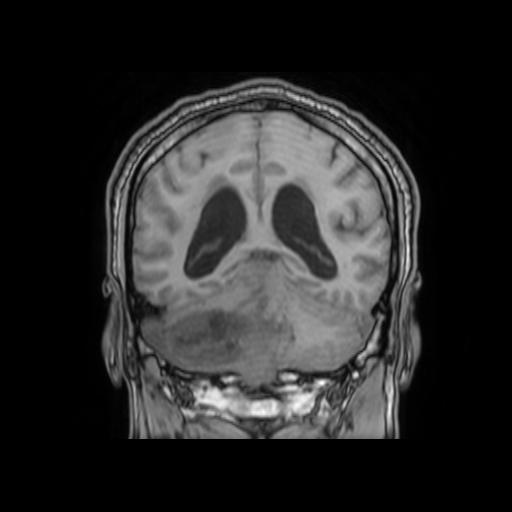 File:Cerebellar hemangioblastoma (Radiopaedia 88055-104622 Coronal T1 25).jpg