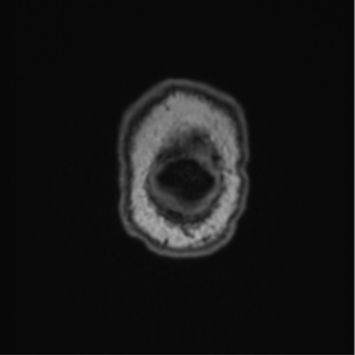 File:Cerebellar hemangioblastomas and pituitary adenoma (Radiopaedia 85490-101176 Coronal T1 6).png