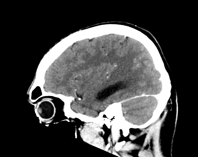 File:Cerebellar hemorrhage (Radiopaedia 37000-38671 Sagittal C+ 26).png