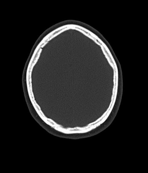 Cerebellar metastases - colorectal adenocarcinoma (Radiopaedia 40947-43652 AX Bone C- 2.0 MPR 51).png