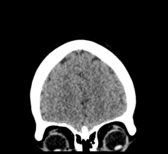 Cerebellar metastases - colorectal adenocarcinoma (Radiopaedia 40947-43652 Coronal non-contrast 21).png