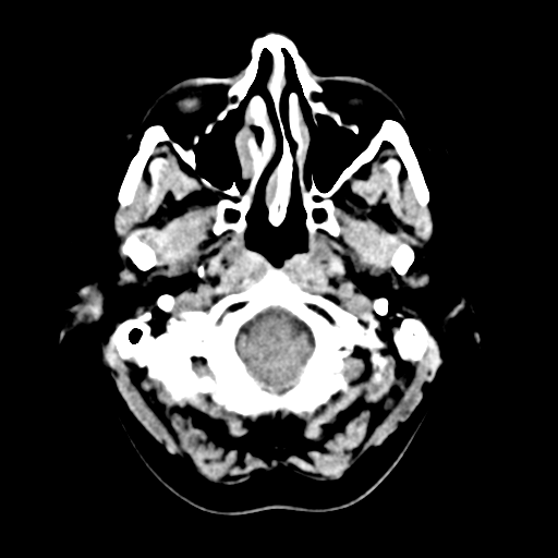 Cerebellar metastasis (Radiopaedia 54578-60812 Axial non-contrast 5).png