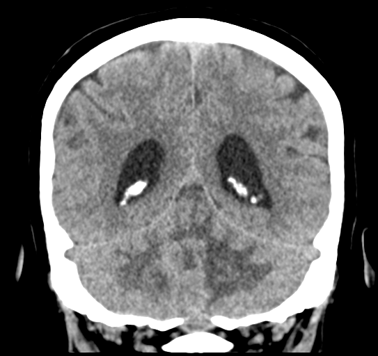 File:Cerebellar metastasis (Radiopaedia 54578-60812 Coronal non-contrast 41).png