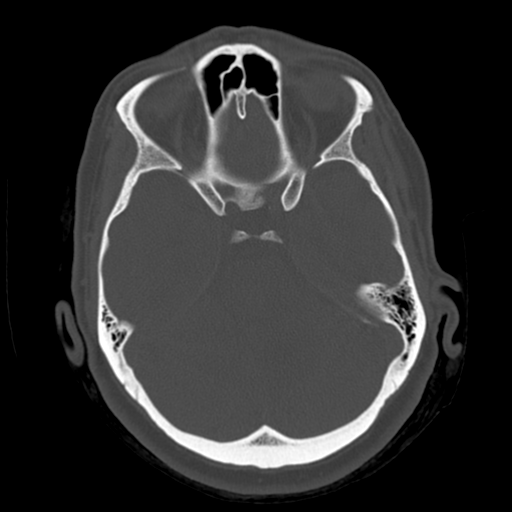 Cerebellar metastasis (cystic appearance) (Radiopaedia 41395-44258 Axial bone window 21).png