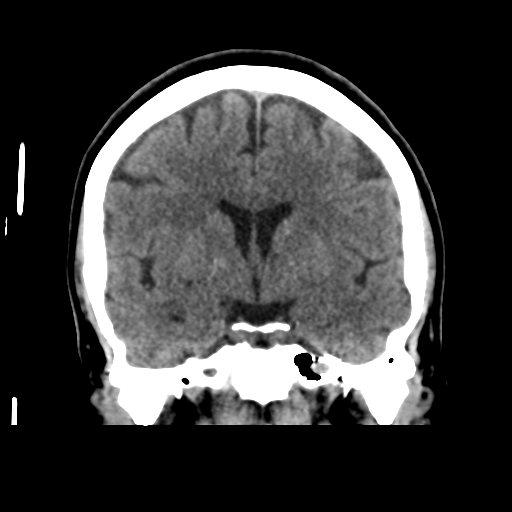 Cerebellar metastasis (cystic appearance) (Radiopaedia 41395-44258 Coronal non-contrast 30).png
