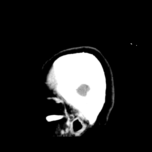 File:Cerebellar metastasis (cystic appearance) (Radiopaedia 41395-44258 F 6).png