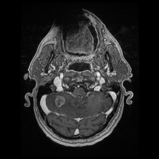 File:Cerebellar metastasis of pulmonary adenocarcinoma, cavernous venous malformation, and developmental venous anomaly (Radiopaedia 85827-101661 Axial T1 C+ 24).jpg