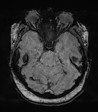 Cerebellopontine angle meningioma (Radiopaedia 48434-53348 Axial SWI 31).png