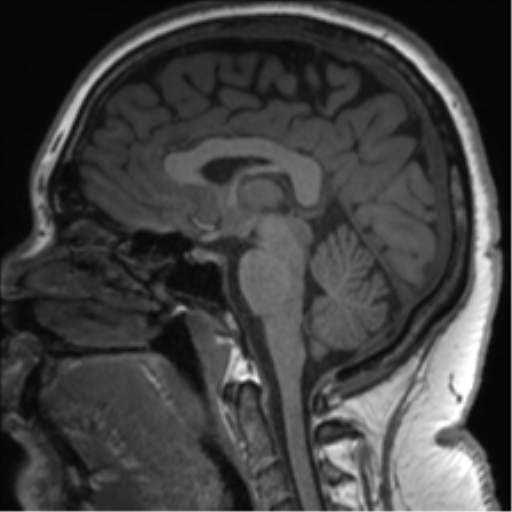 Cerebellopontine angle meningioma (Radiopaedia 48434-53348 Sagittal T1 48).png