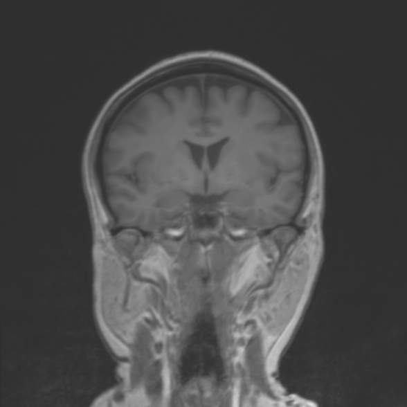 File:Cerebellopontine angle meningioma (Radiopaedia 53561-59591 Coronal T1 11).jpg