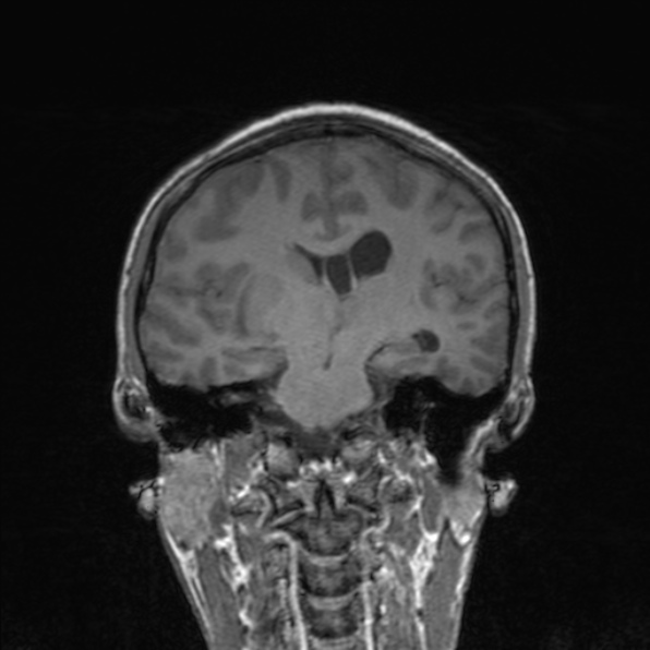 Cerebral abscess (Radiopaedia 24212-24478 Coronal T1 119).jpg