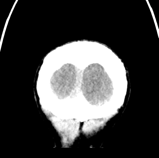 Cerebral abscess (Radiopaedia 60342-68008 Coronal non-contrast 61).png