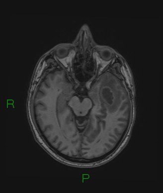 File:Cerebral abscess and subdural empyema (Radiopaedia 84436-99779 Axial T1 52).jpg