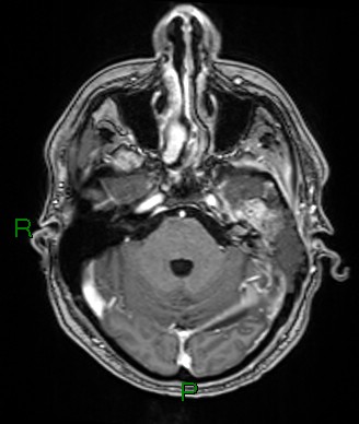 Cerebral abscess and subdural empyema (Radiopaedia 84436-99779 Axial T1 C+ 63).jpg