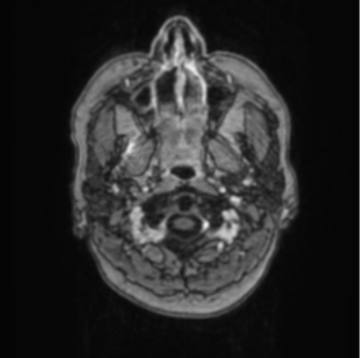 Cerebral abscess from pulmonary arteriovenous malformation (Radiopaedia 86275-102291 Axial T1 C+ 3).png