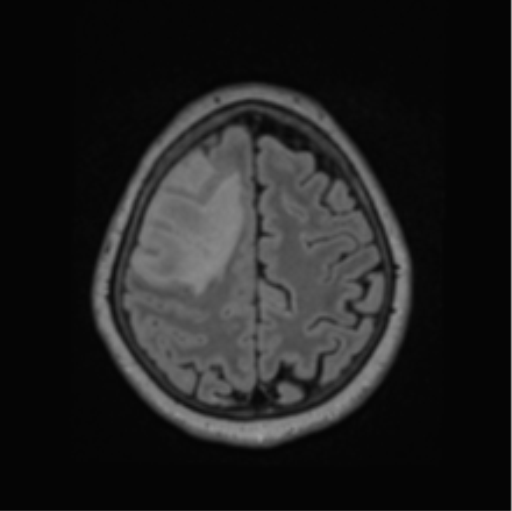 File:Cerebral abscess from pulmonary arteriovenous malformation (Radiopaedia 86275-102291 J 59).png
