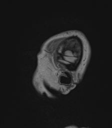 Cerebral abscess from pulmonary arteriovenous malformation (Radiopaedia 86275-102291 Sagittal FLAIR 70).png