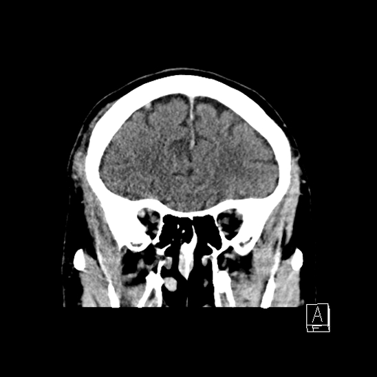 File:Cerebral abscess with ventriculitis (Radiopaedia 78965-91877 B 15).jpg