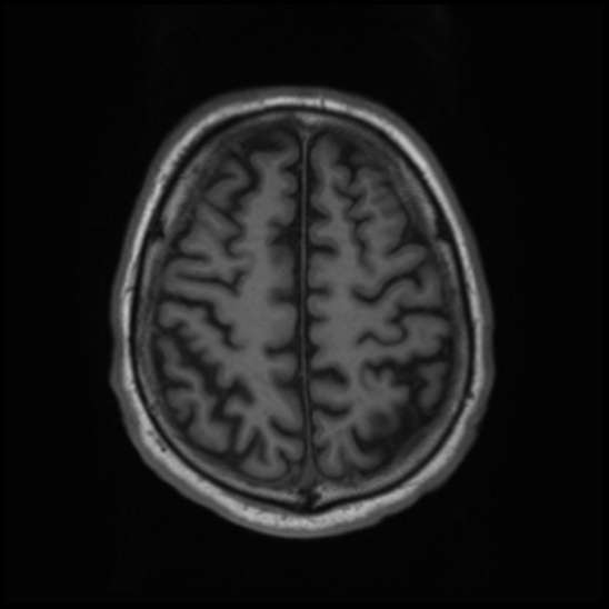 File:Cerebral abscess with ventriculitis (Radiopaedia 78965-91878 Axial T1 39).jpg