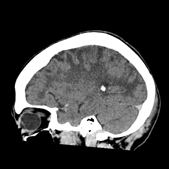 Cerebral amyloid angiopathy-related inflammation (Radiopaedia 74836-85848 C 42).jpg