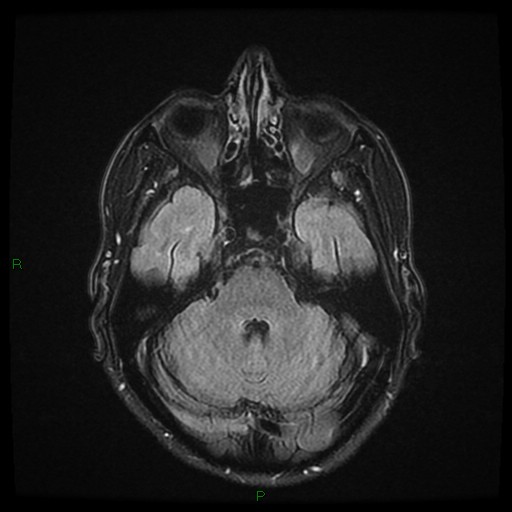 File:Cerebral amyloid angiopathy (Radiopaedia 77506-89664 Axial FLAIR 9).jpg