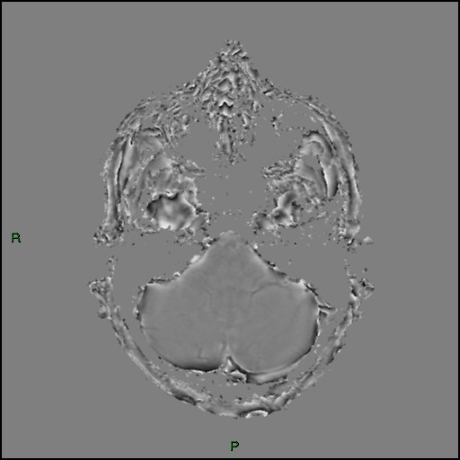 Cerebral amyloid angiopathy (Radiopaedia 77506-89664 H 25).jpg
