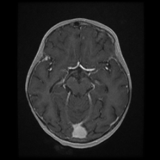Cerebral and spinal tuberculosis (Radiopaedia 90489-107837 Axial T1 C+ 87).jpg