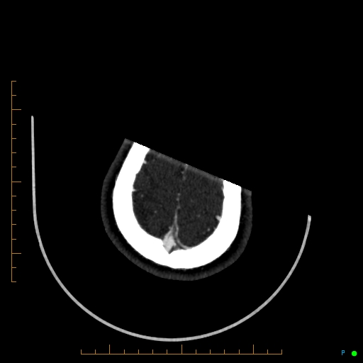 Cerebral arteriovenous malformation (AVM) (Radiopaedia 78162-90706 Axial CTA 244).jpg