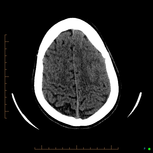 Cerebral arteriovenous malformation (AVM) (Radiopaedia 78162-90706 Axial non-contrast 52).jpg