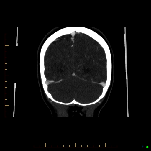 Cerebral arteriovenous malformation (AVM) (Radiopaedia 78162-90706 Coronal CTA 24).jpg