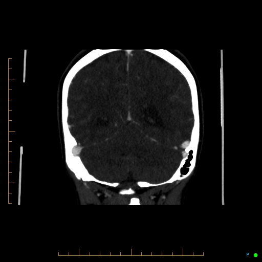 Cerebral arteriovenous malformation (AVM) (Radiopaedia 78162-90706 Coronal CTA 32).jpg