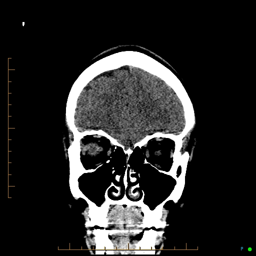 File:Cerebral arteriovenous malformation (AVM) (Radiopaedia 78162-90706 Coronal non-contrast 22).jpg